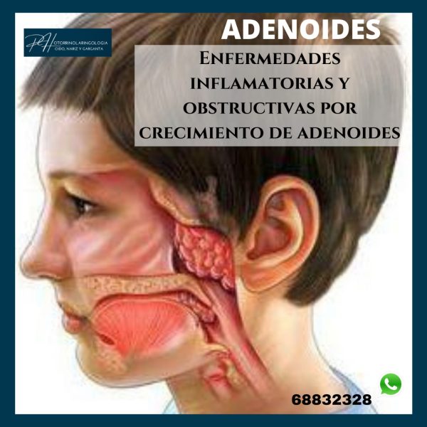 Adenoides y enfermedades inflamatorias.