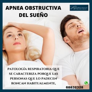 Apnea obstructiva del sueño.