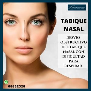 Desvio de tabique nasal.